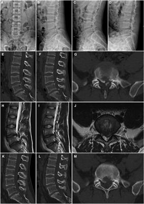 Percutaneous endoscopic lumbar discectomy as a treatment for lumbar disc herniation linked with posterior ring <mark class="highlighted">apophysis</mark> separation